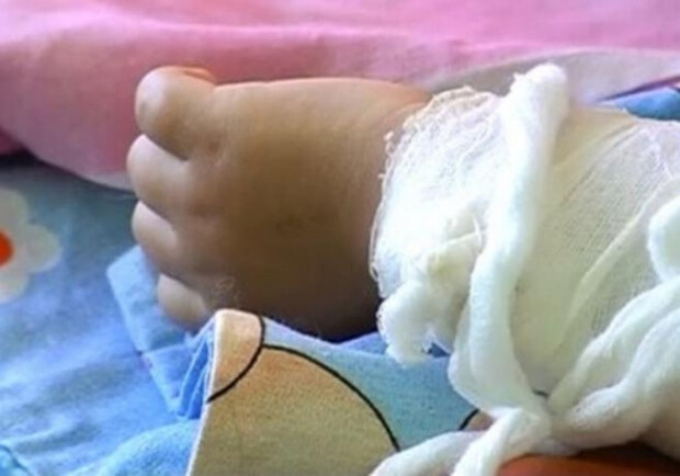 В запорожскую больницу попал малыш с сильными ожогами. Фото: bbc